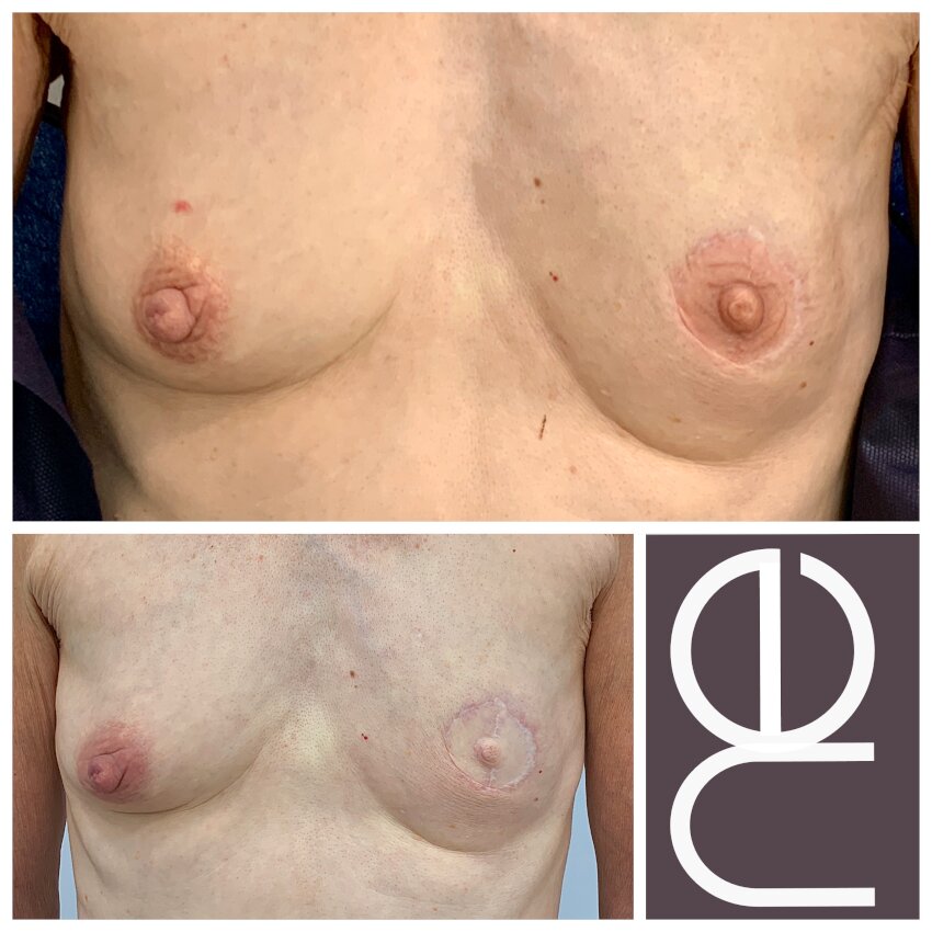 Natural Enhancement Semi Permanent Areola Before And After
